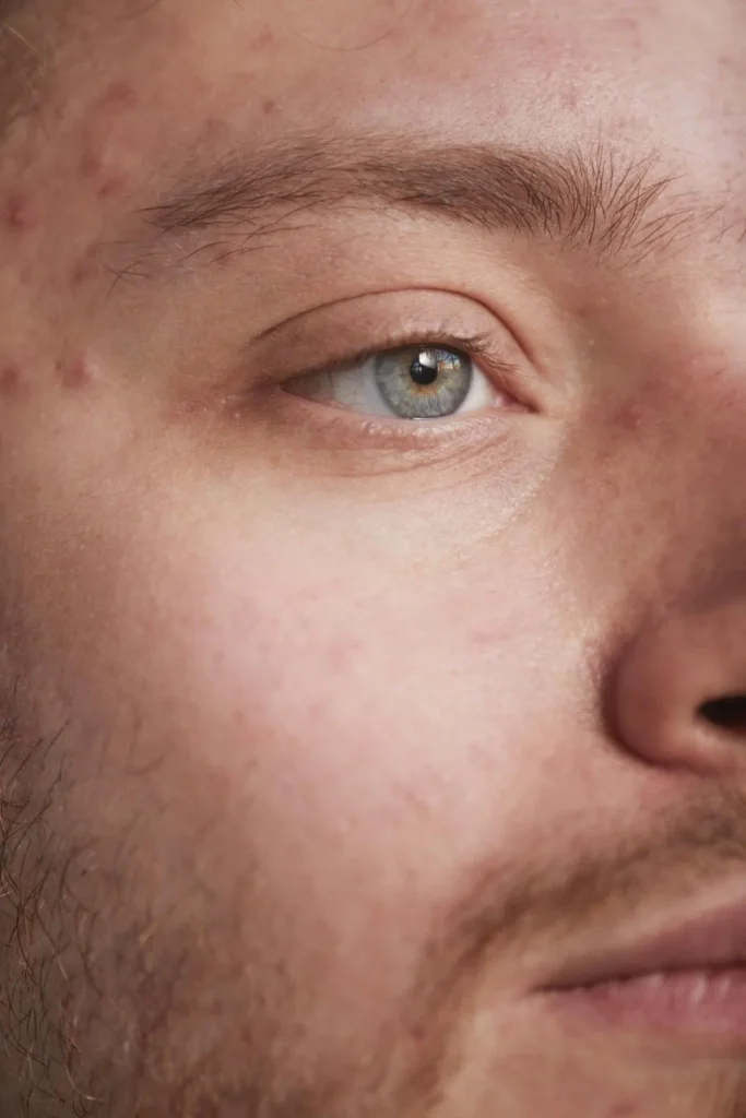 Male skin with acne marks before niacinamide serum